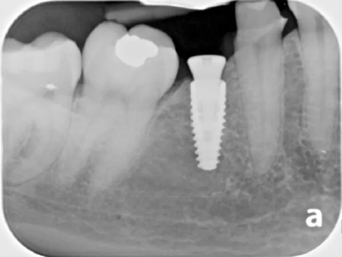 Dental X-ray of a dental implant in the lower jaw