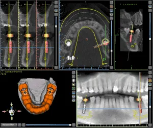 Digital implant planning software showing a 3D treatment plan