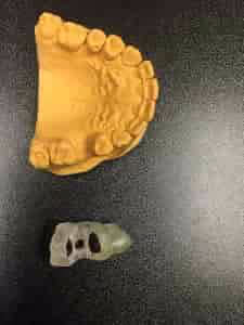 Dental cast model with an implant surgical guide