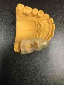 Implant surgical guide fitted on a dental cast