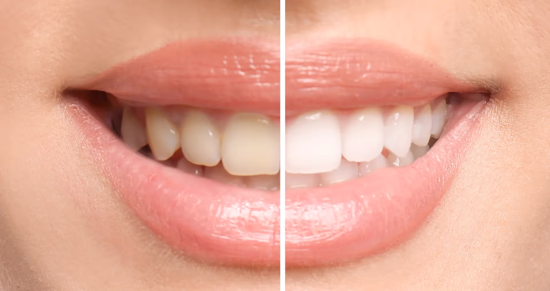 Why Choose Professional Teeth Whitening?