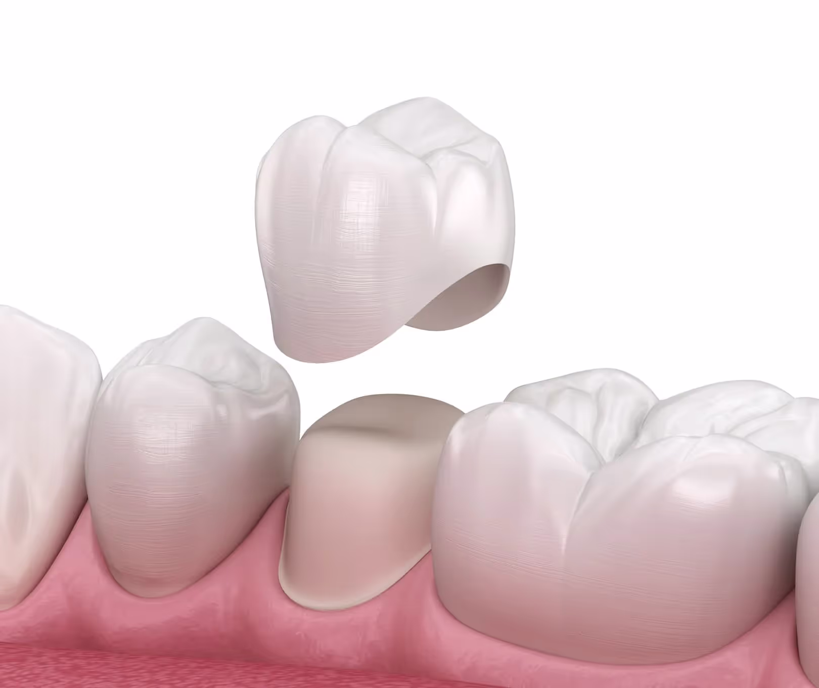Why You Might Need a Dental Crown