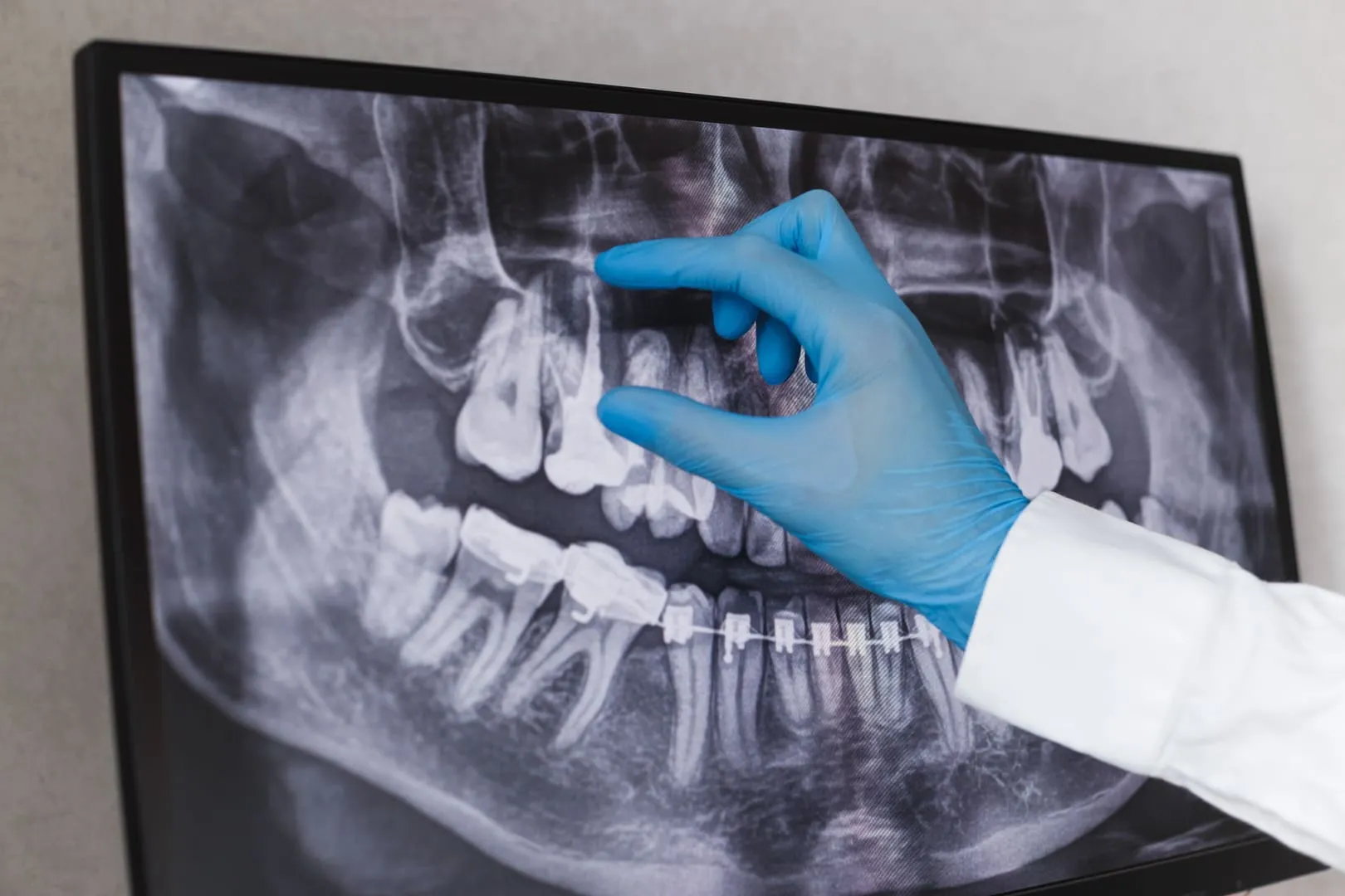 Understanding Root Canal Treatment