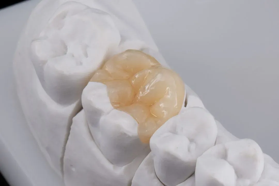 What are Dental Inlays and Onlays?