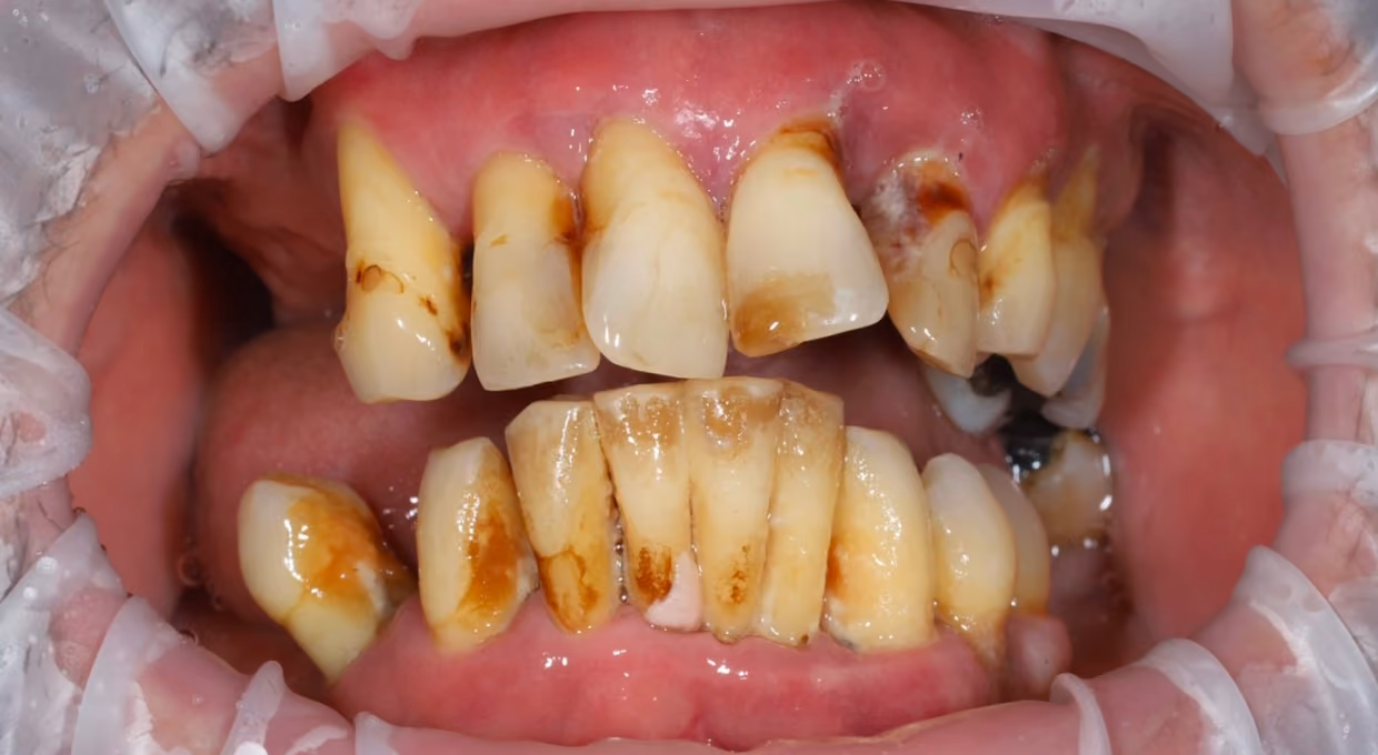 Close-up of upper and lower teeth and gums with a dental retractor in place.