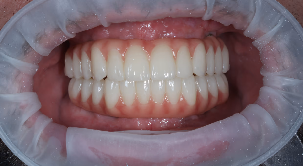 Close-up of healthy upper and lower teeth with pink gums in a dental mouth retractor.