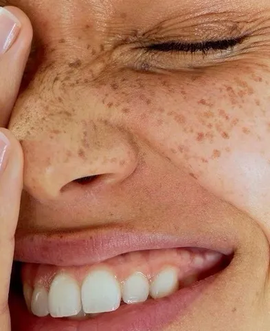 Close-up of a smiling person with freckles, closed eyes, and fingers touching their face.