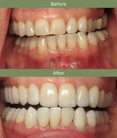 Close-up of teeth before and after dental treatment showing improved alignment and whitening.