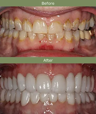 Comparison of teeth before and after dental cleaning, showing yellow stains removed and whiter teeth after.