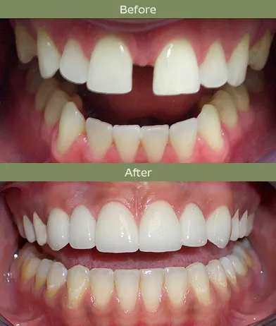 Before and after images showing teeth with gaps then corrected to aligned, gap-free teeth.