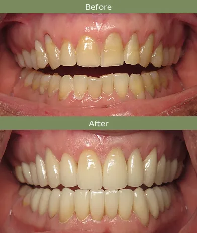 Before and after images showing dental restoration with whiter and evenly shaped teeth in the after photo.