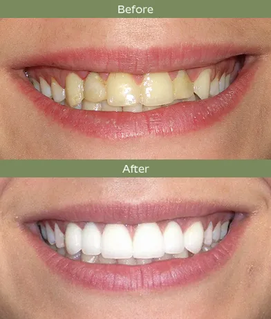 Side-by-side before and after close-up of teeth showing yellow discoloration and gaps then white, even teeth.
