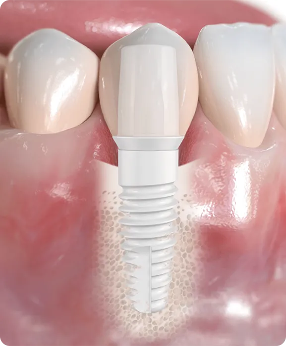 Cross-section of dental implant inserted in jawbone with surrounding natural teeth and gums.