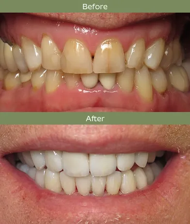 Before and after comparison showing stained, discolored teeth transformed into clean, white teeth.