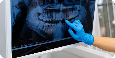 Hand in blue glove pointing at a dental X-ray showing teeth and jawbone on a screen.