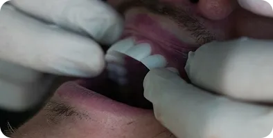 Dentist wearing gloves examining a patient's teeth and gums inside the mouth.