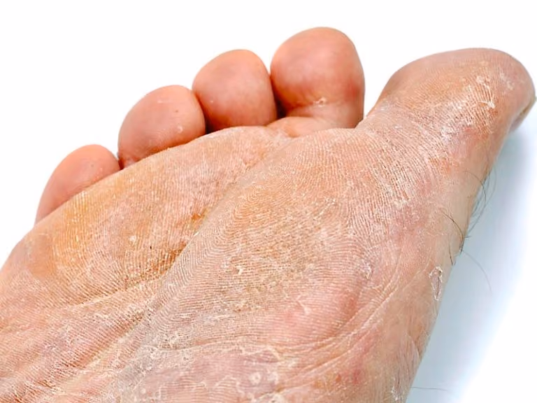 Dry, scaling skin on the sole of the foot from athlete's foot