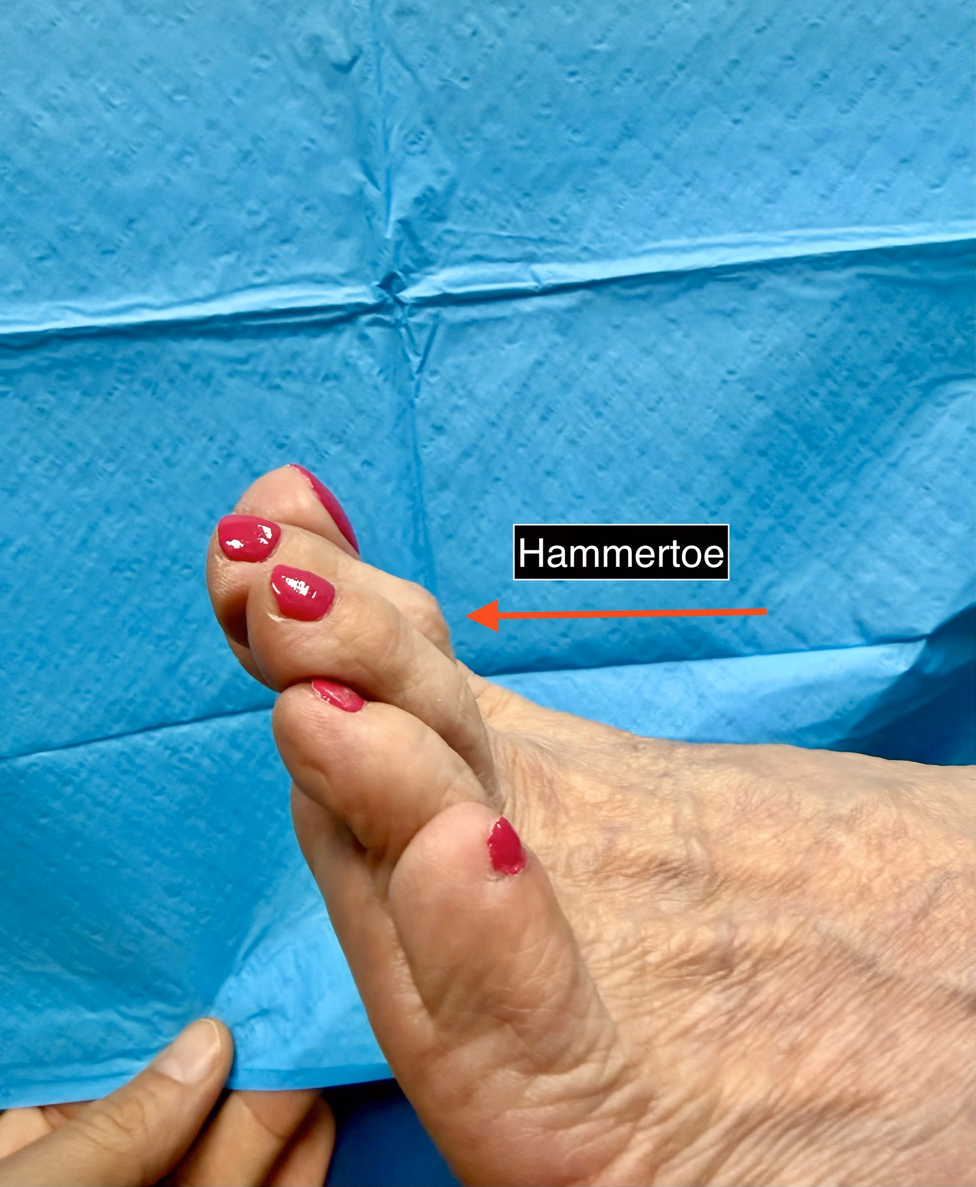 Foot with hammertoe deformity