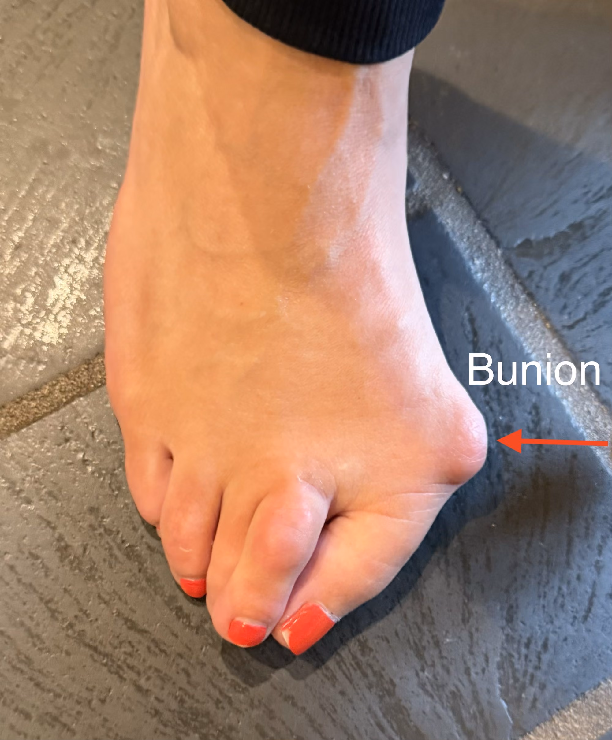 Foot with a bunion at the base of the big toe