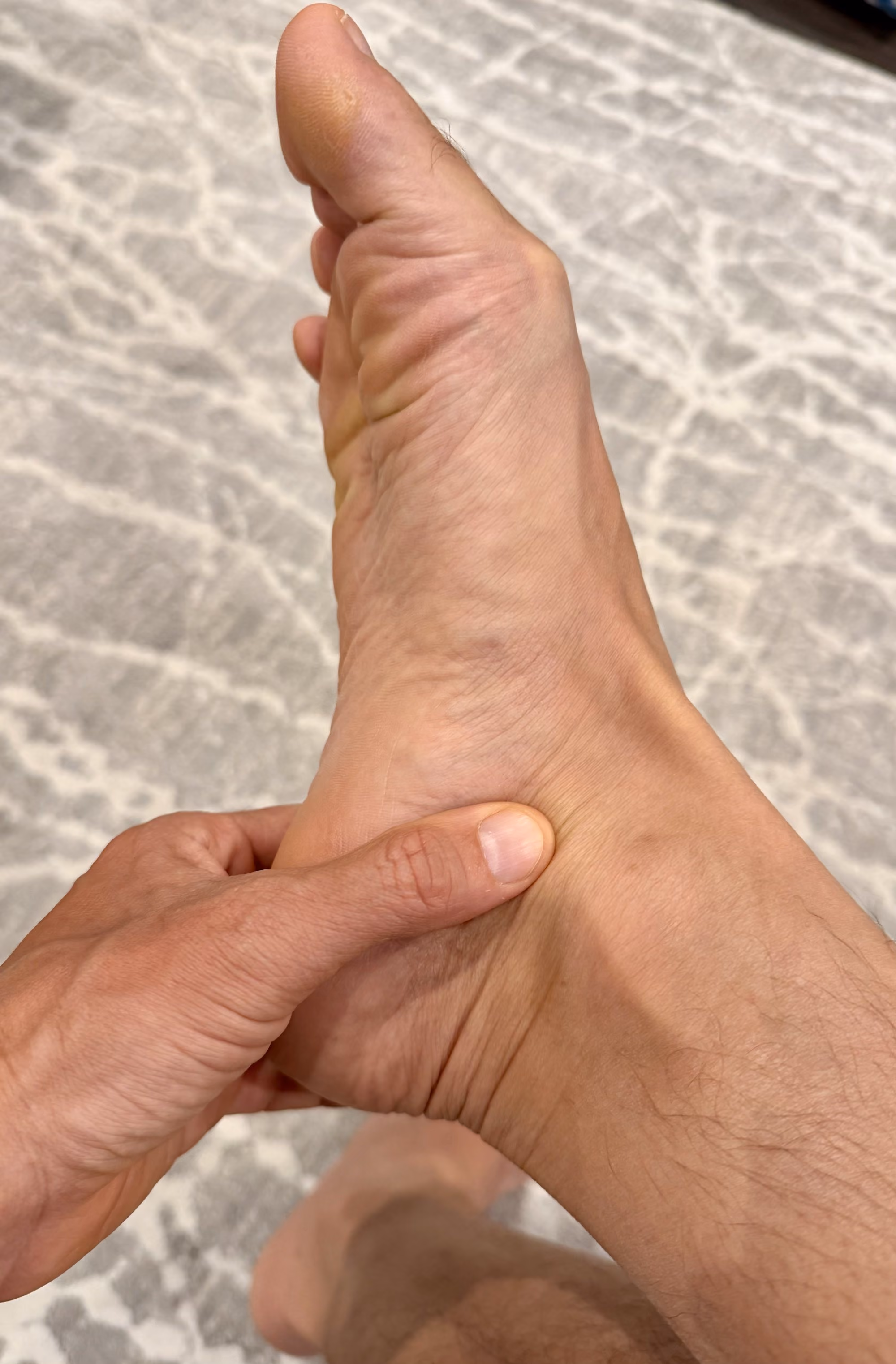 Foot with a flattening arch from posterior tibial tendon dysfunction