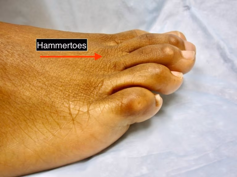 Foot with hammertoe deformity of the lesser toes
