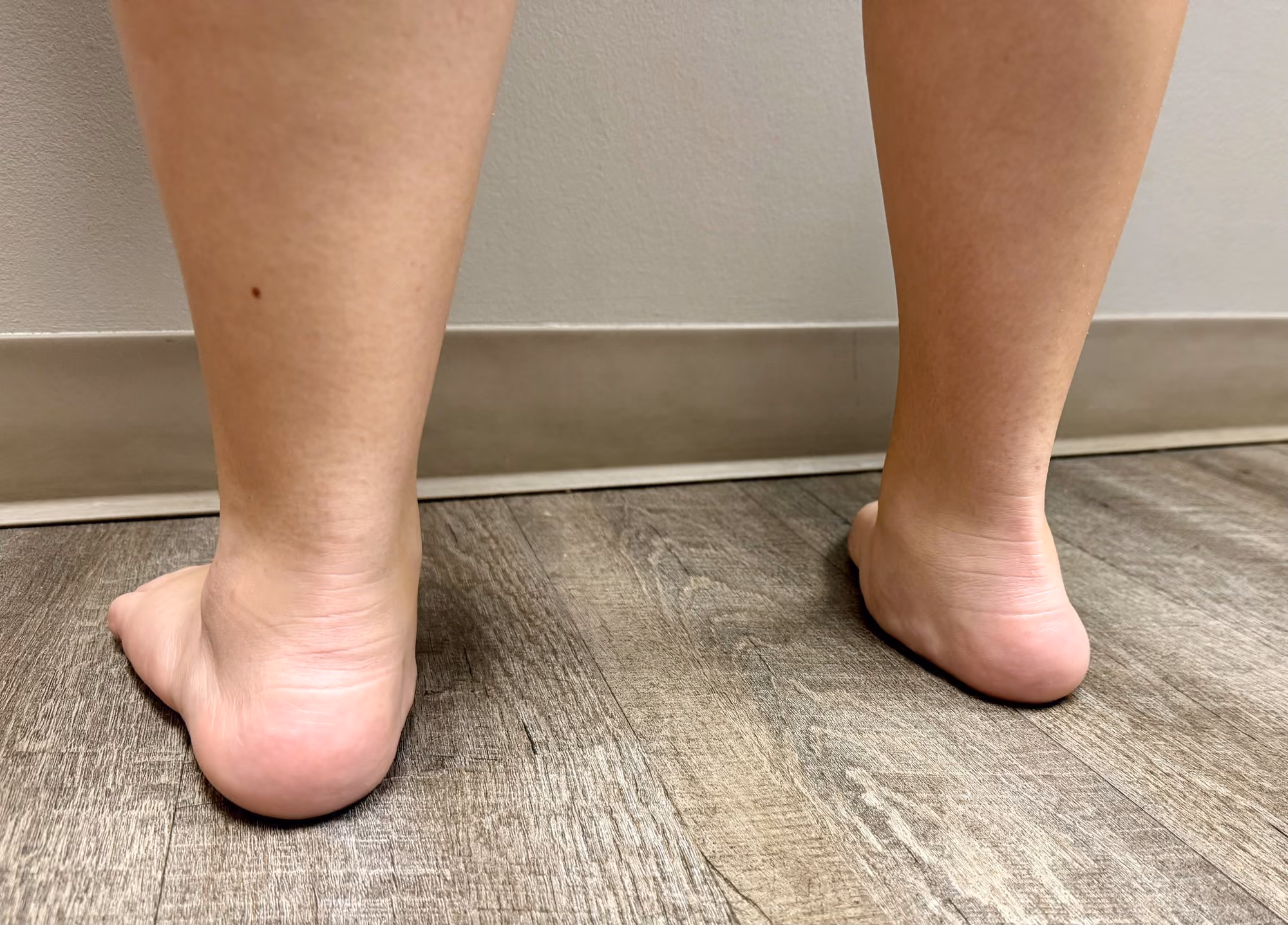 Rear view of flat feet with collapsed arches