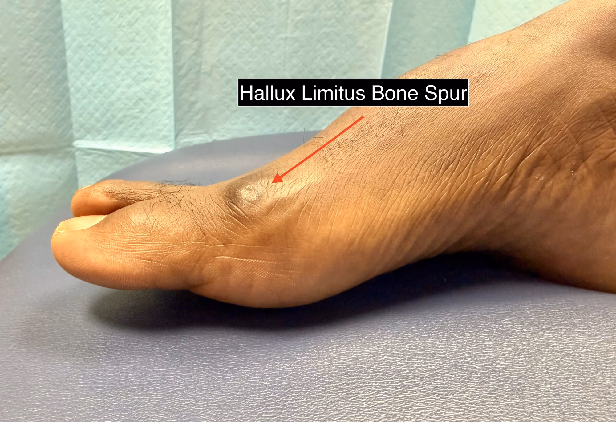 Hallux limitus causing a stiff, painful big toe