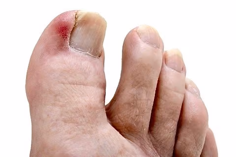 Ingrown toenail along the edge of the nail