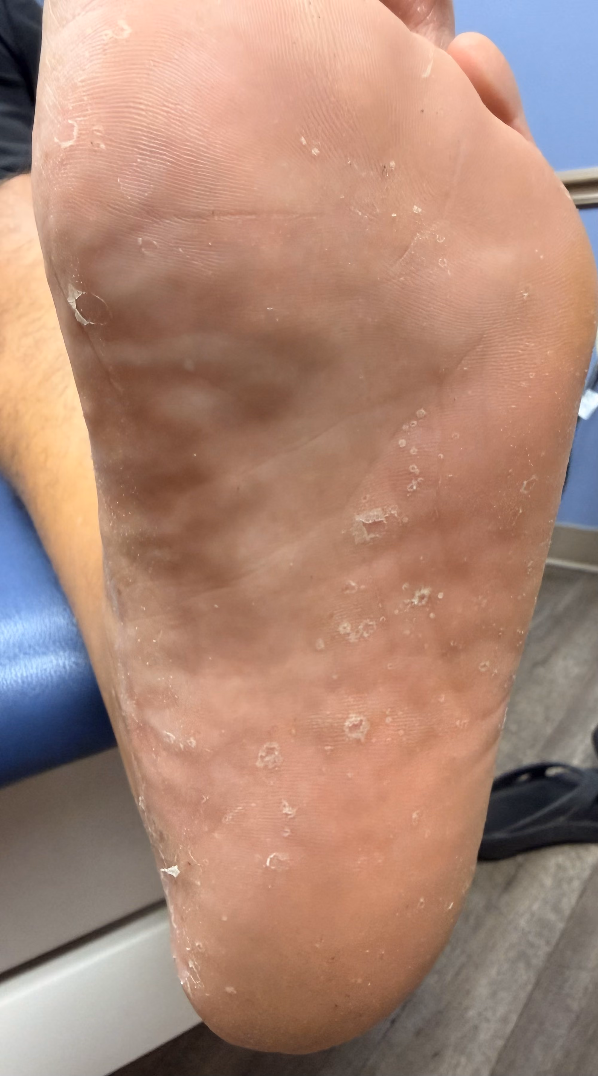 Athlete's foot causing itching and scaling skin