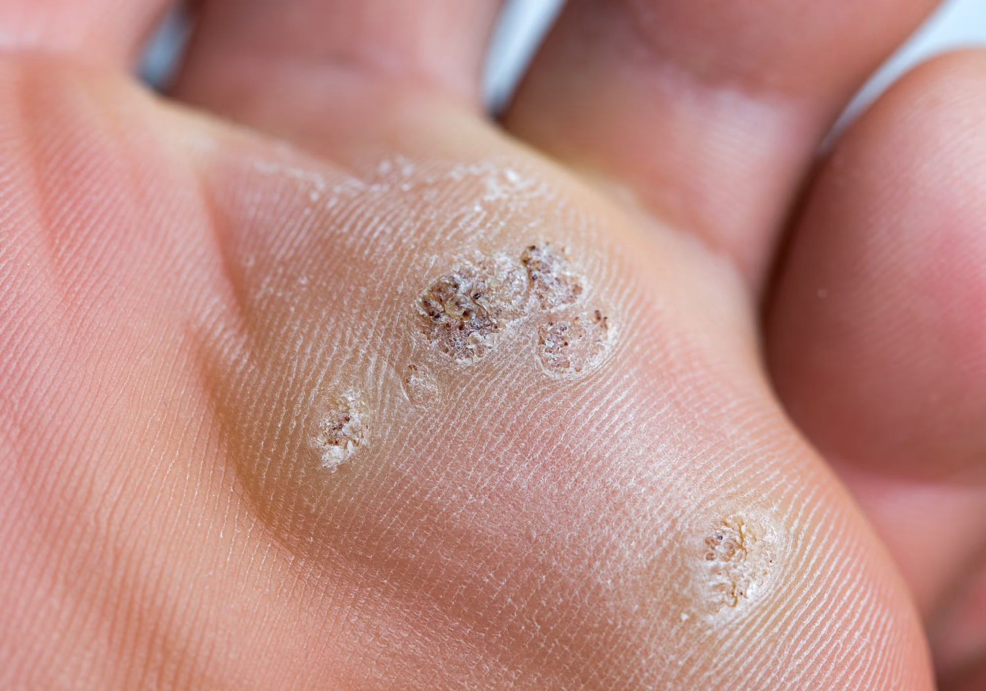 Plantar wart on the sole of the foot