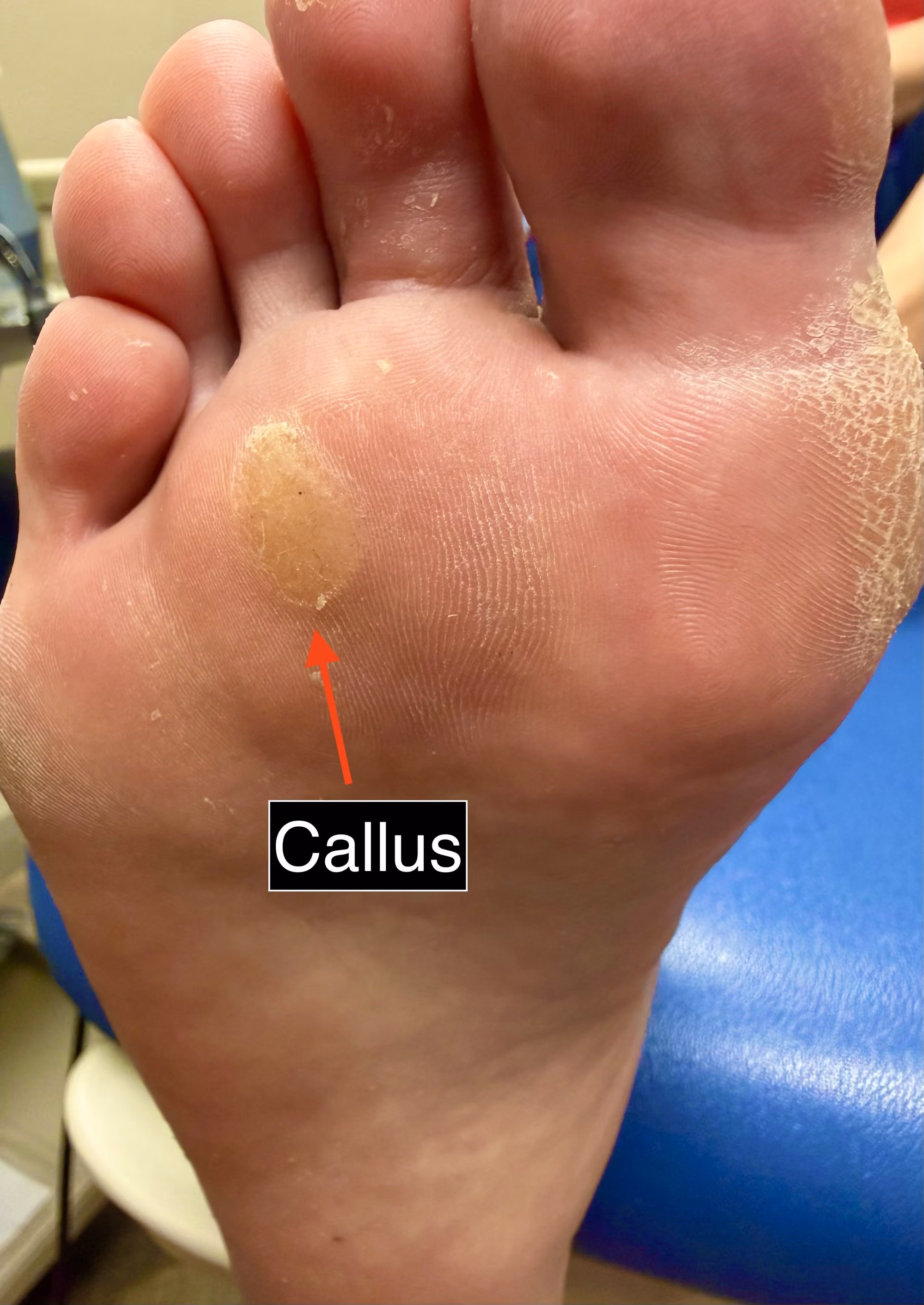 Corns and calluses on the foot