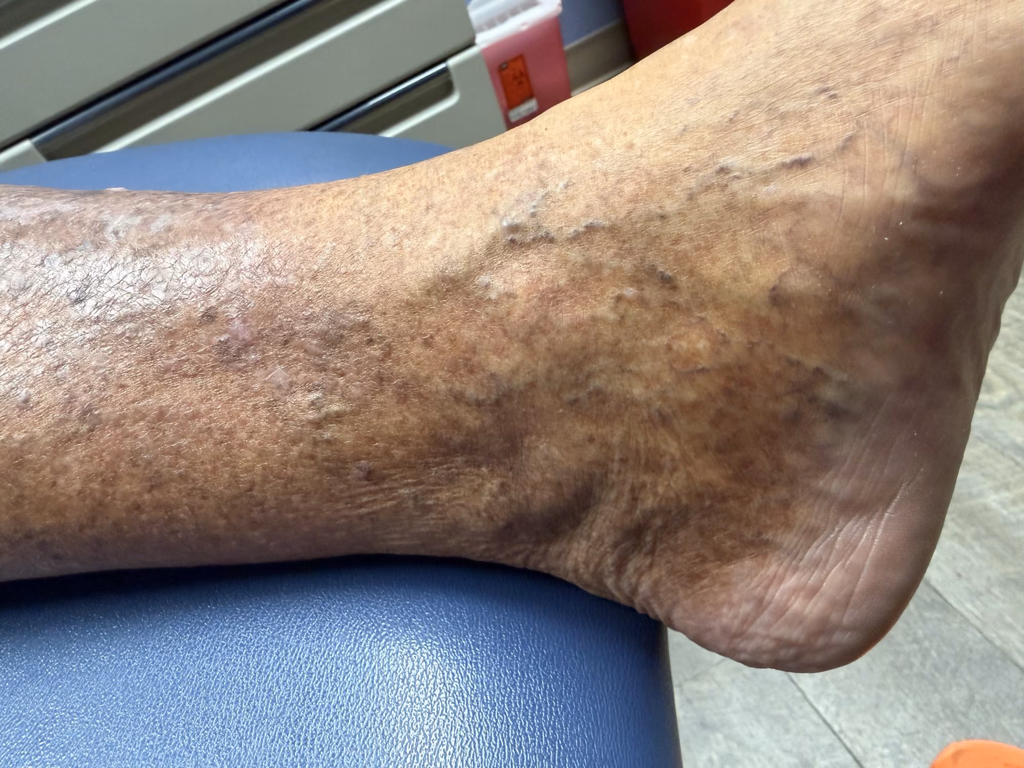 Venous stasis and swelling of the lower leg