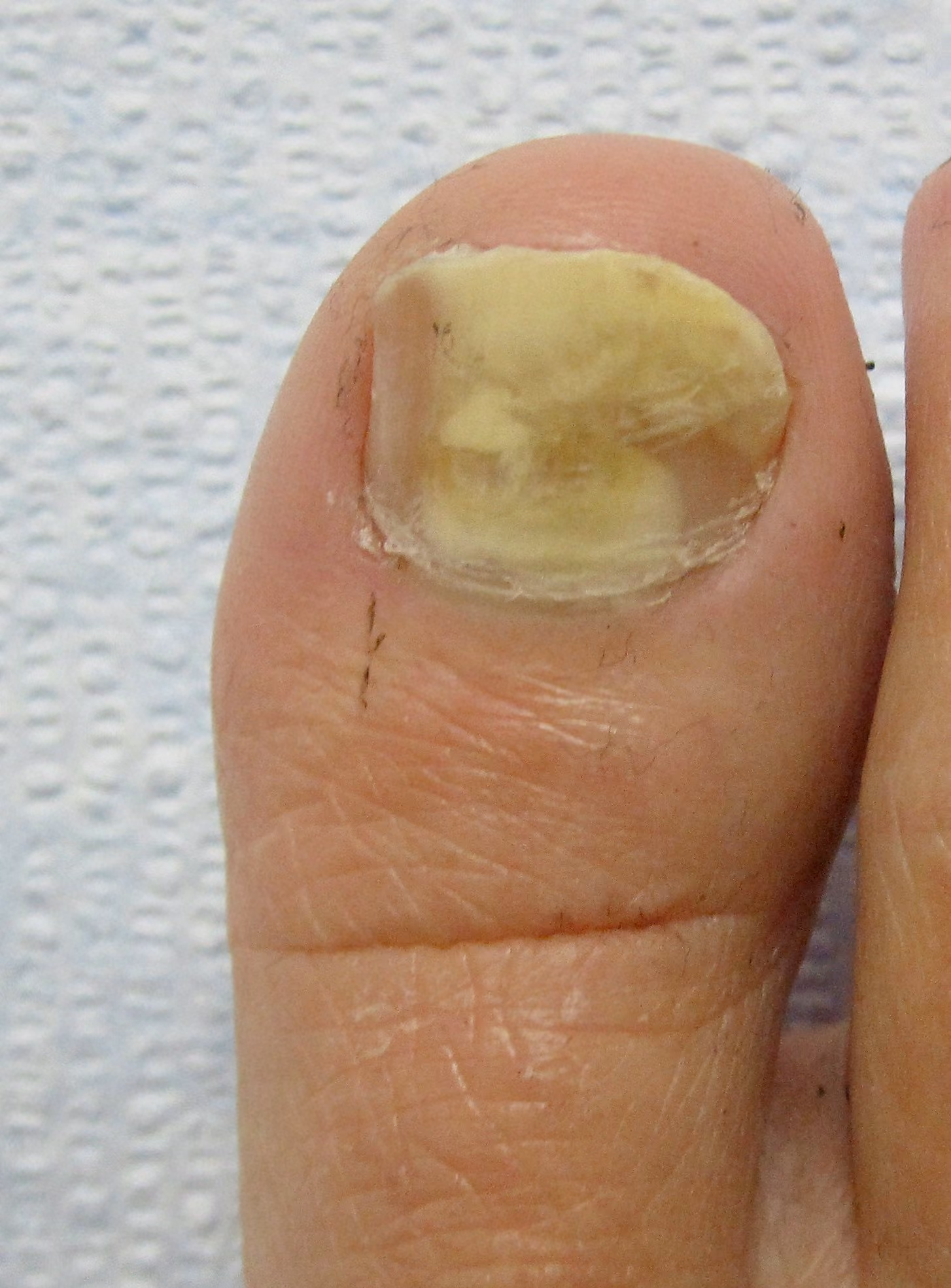 Thickened, discolored toenails from toenail fungus
