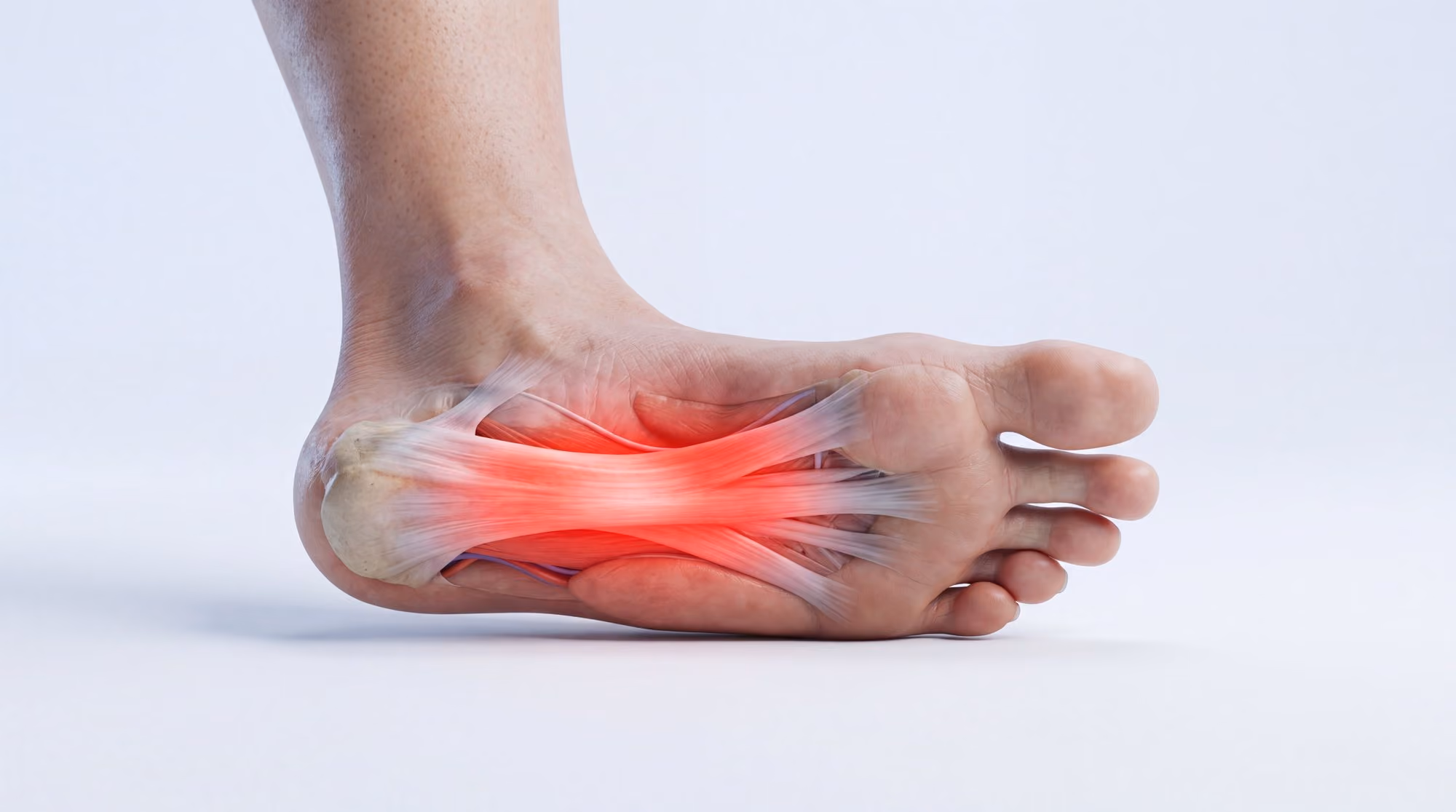 Illustration of inflammation along the plantar fascia causing heel pain