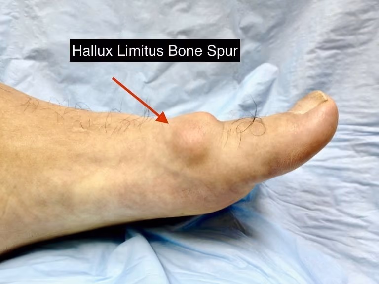 Bone spur at the big toe joint from hallux limitus