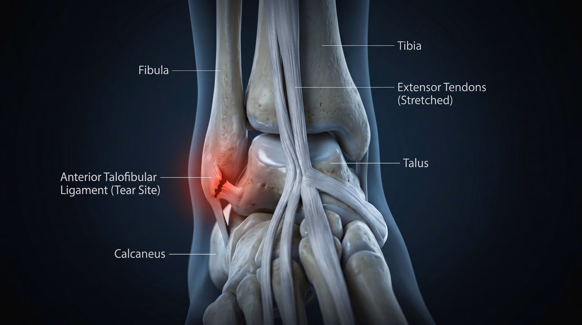 Illustration of the ankle ligaments and the tear site in an ankle sprain