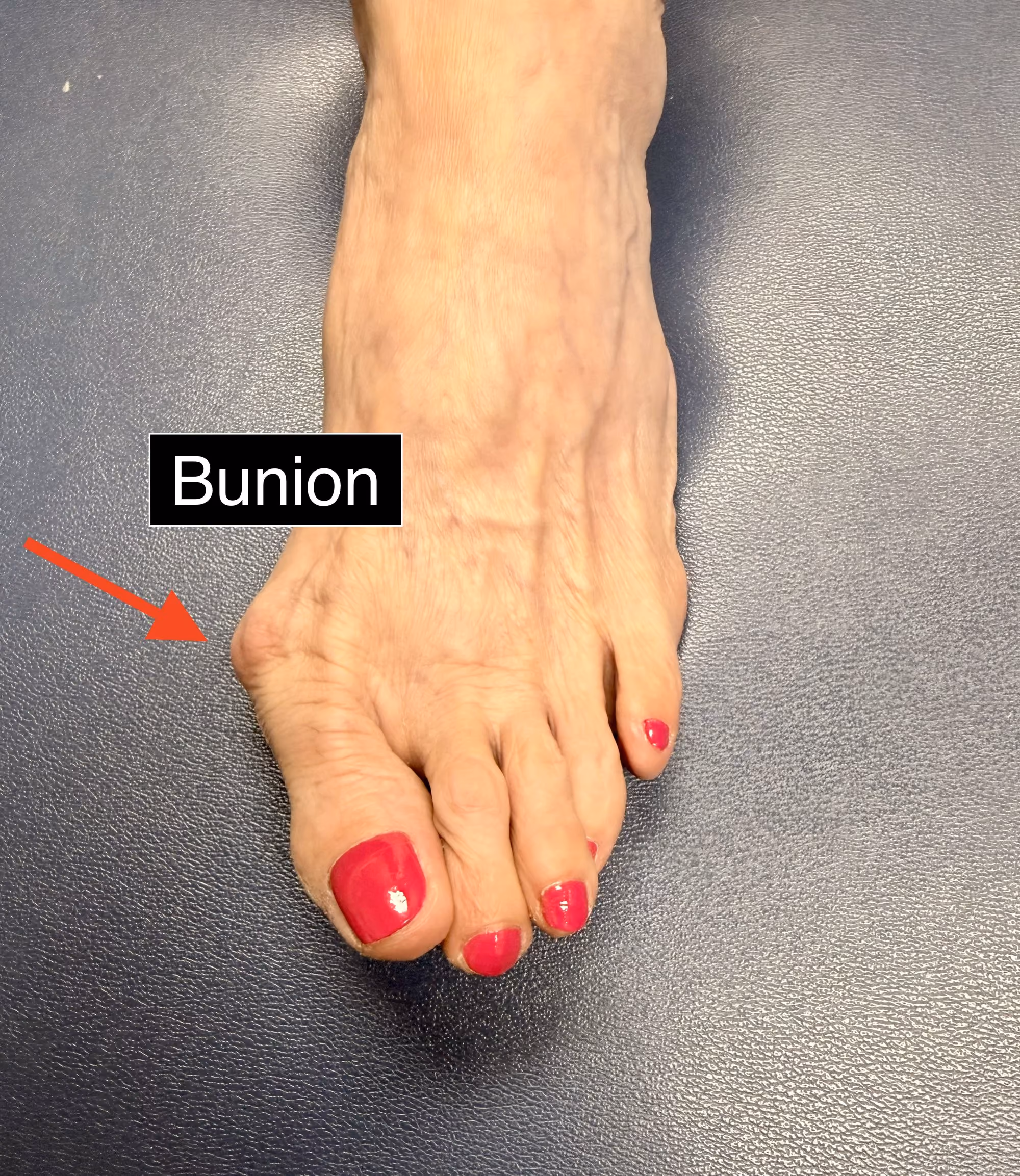 Close-up of a bunion on the big toe joint