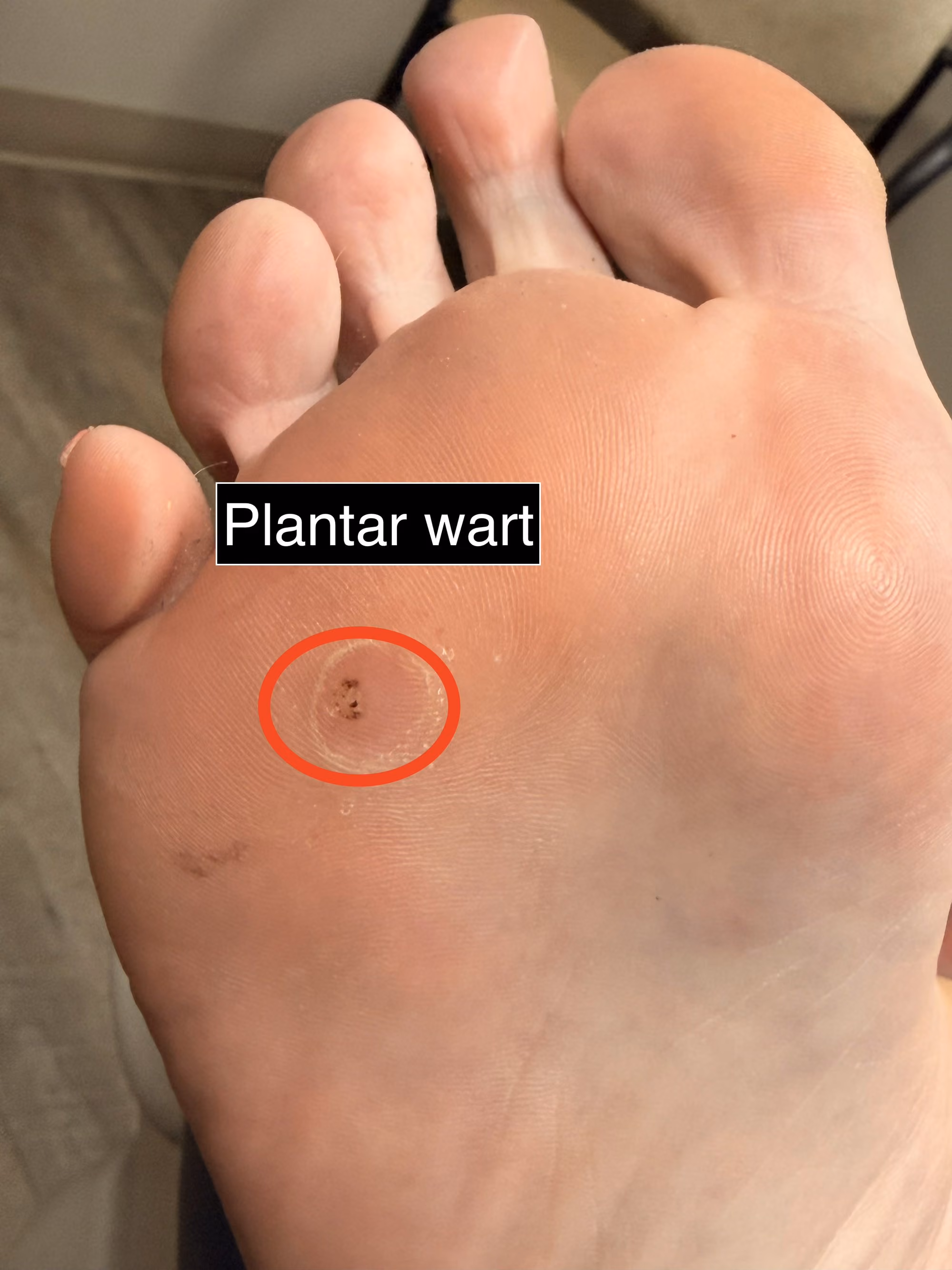 Plantar wart on the sole of the foot, marked for treatment