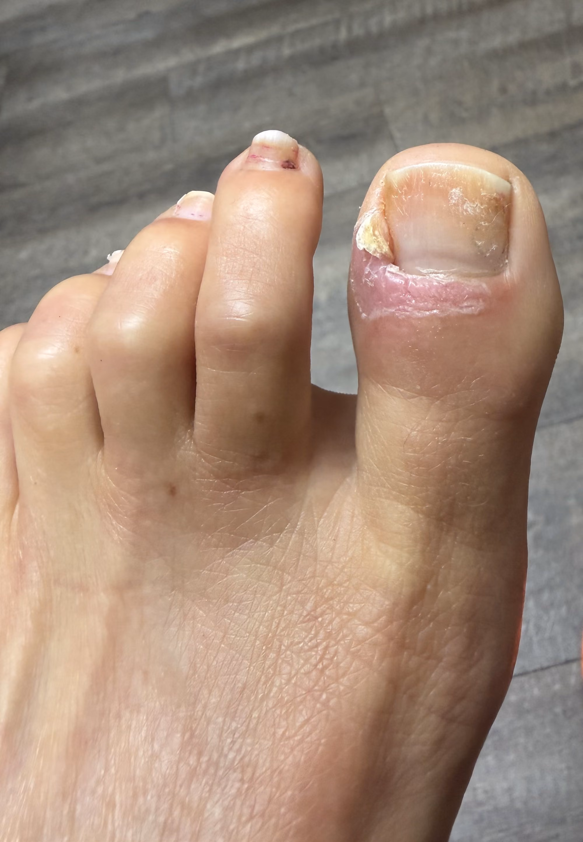 Ingrown and thickened big toenail