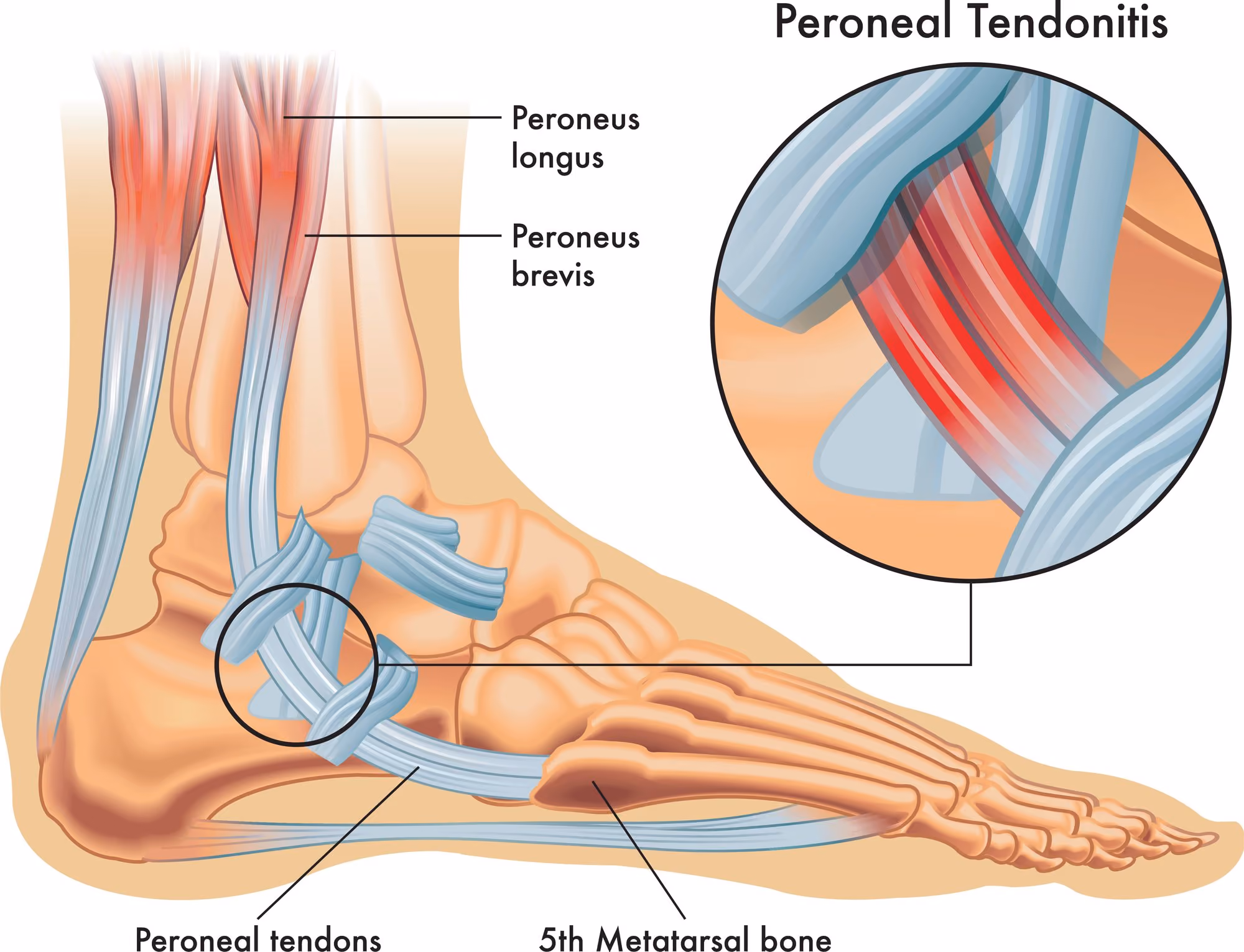 Illustration of the peroneal tendons along the outer ankle