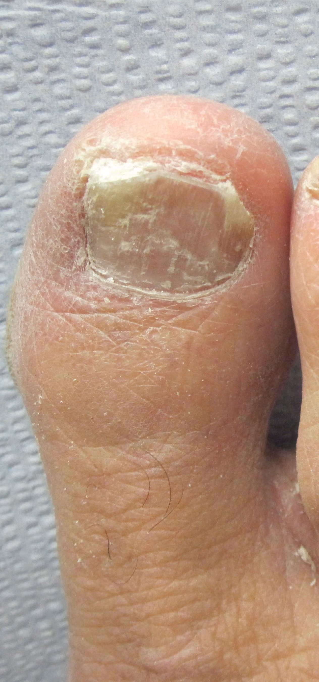 Thickened, yellow big toenail caused by fungus