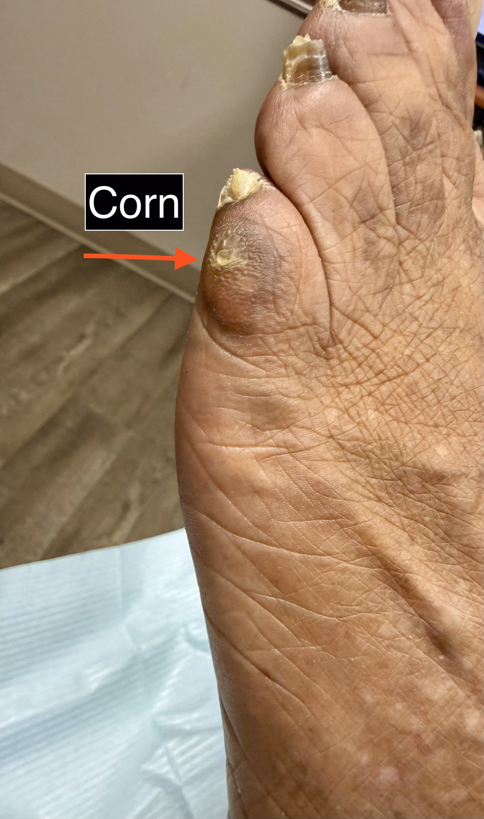 Corn on the side of the little toe