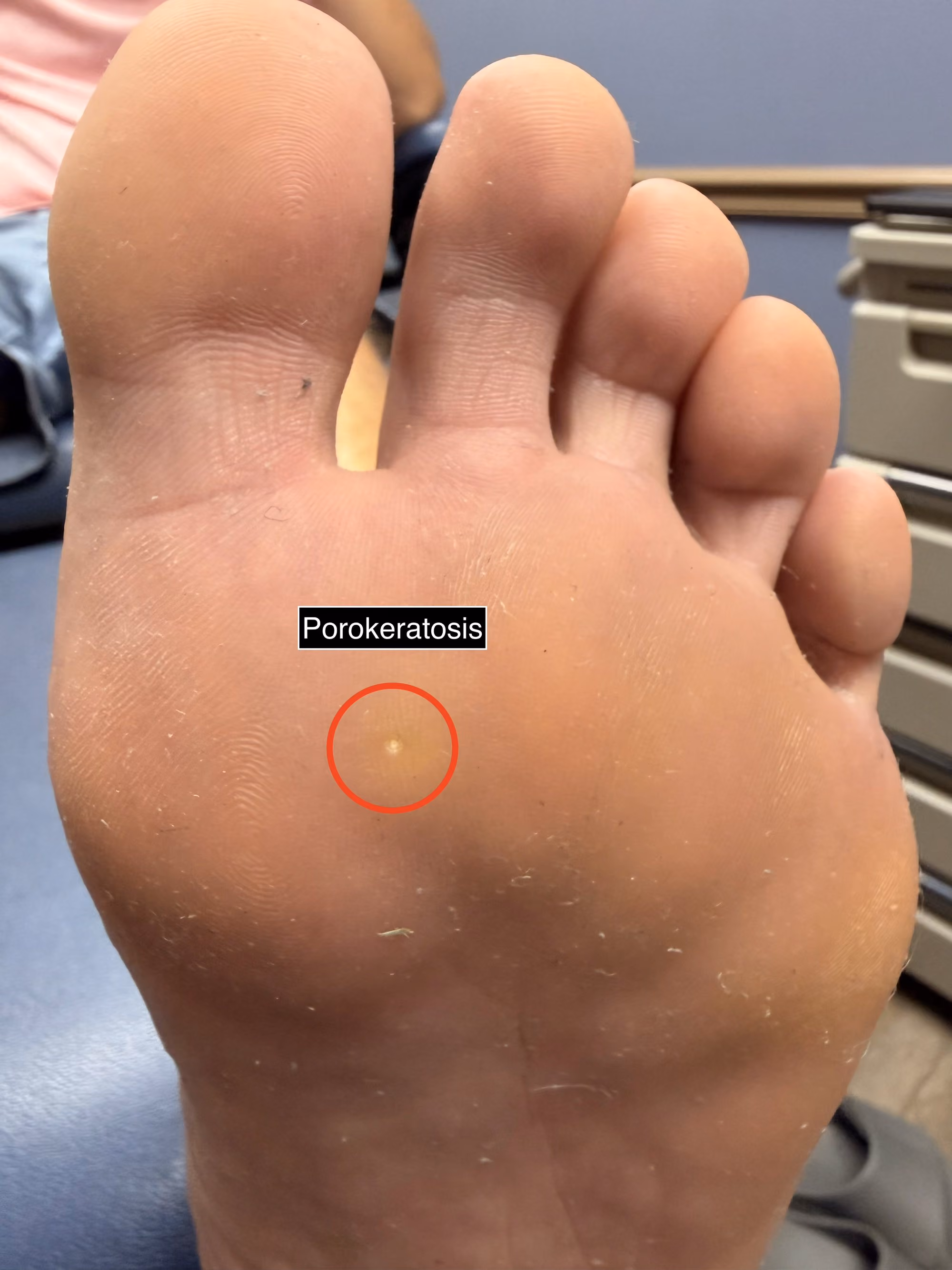 Porokeratosis on the sole of the foot, marked for treatment