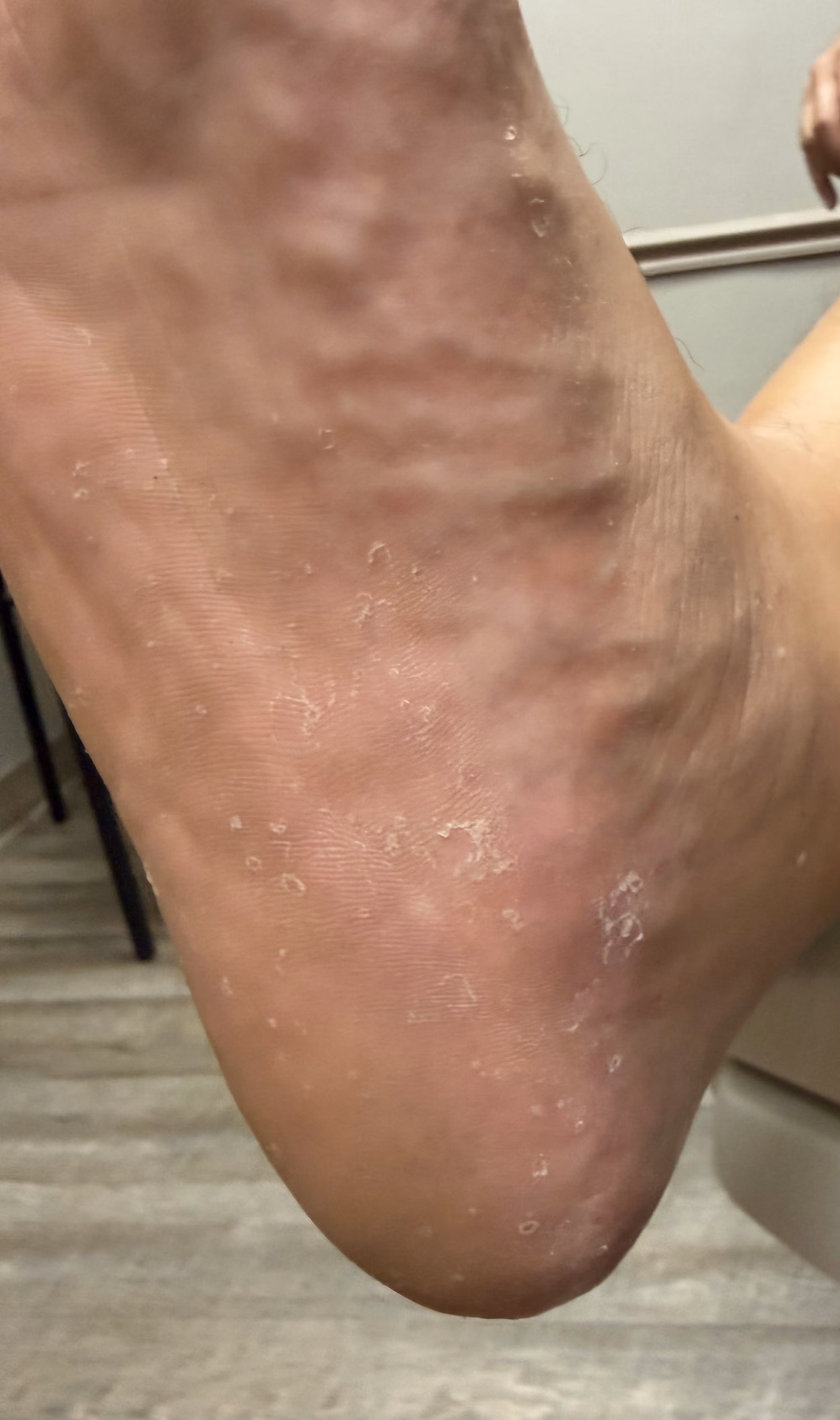 Dry, scaling skin on the sole of the foot from athlete's foot