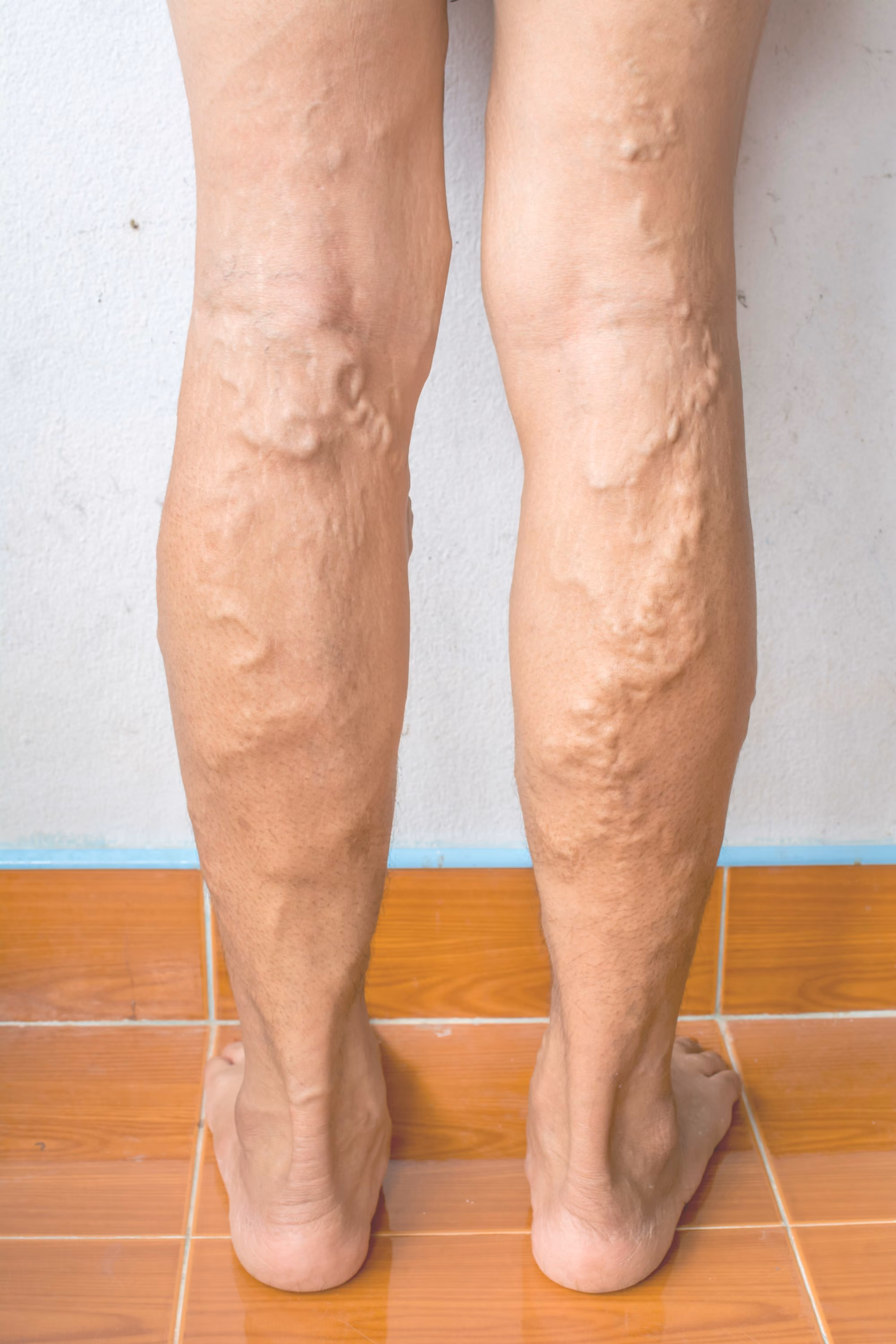 Varicose veins in the lower legs