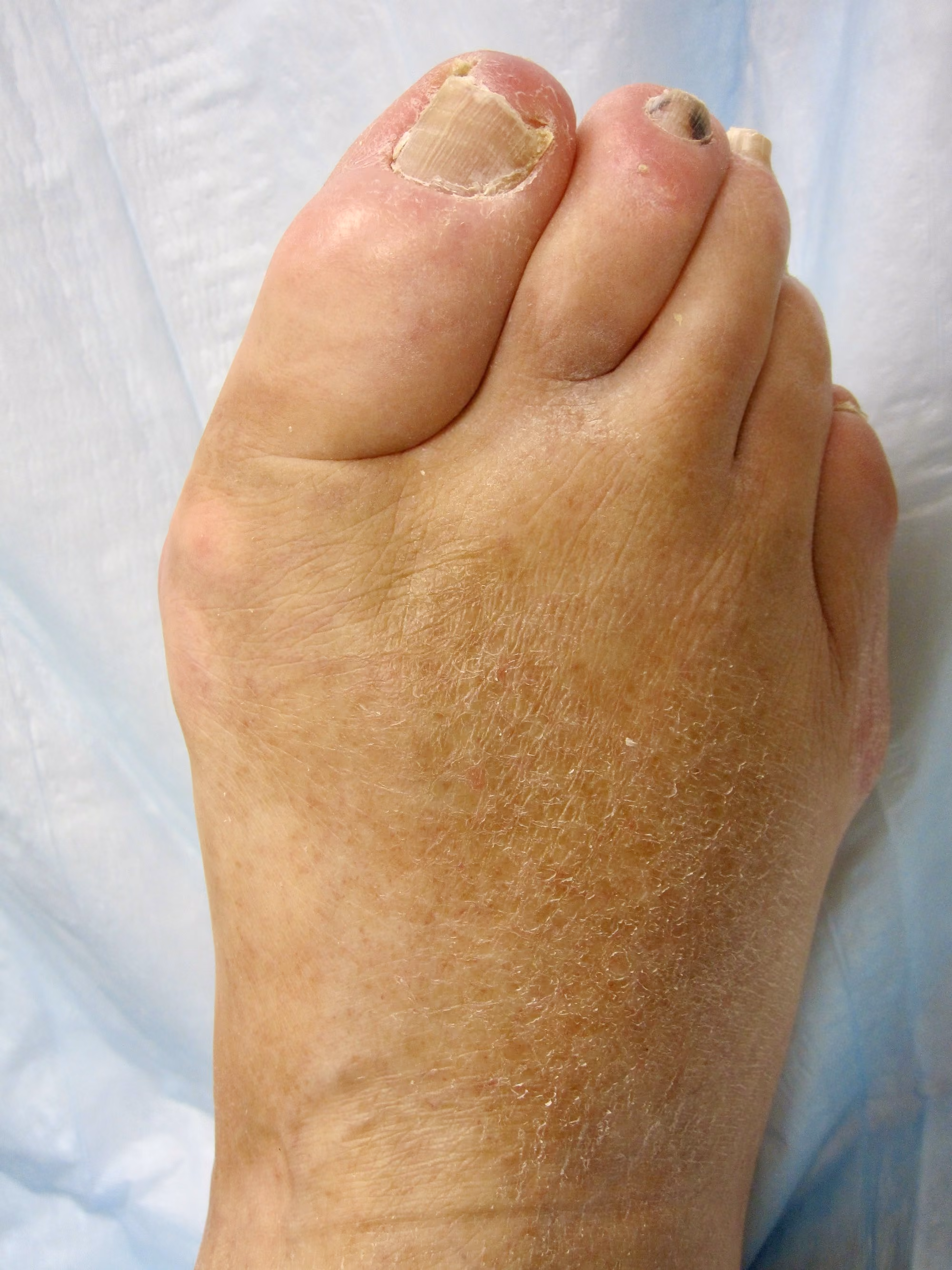 Swollen foot and ankle from edema