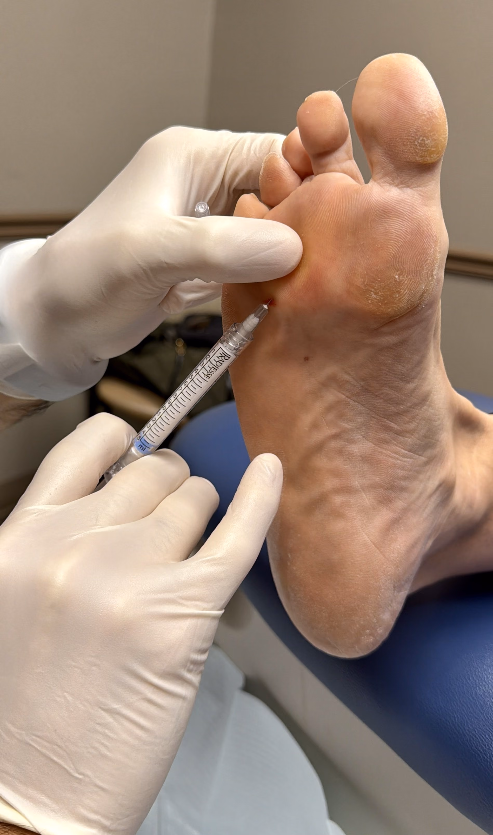 Dermal filler being injected into the ball of the foot for fat pad atrophy