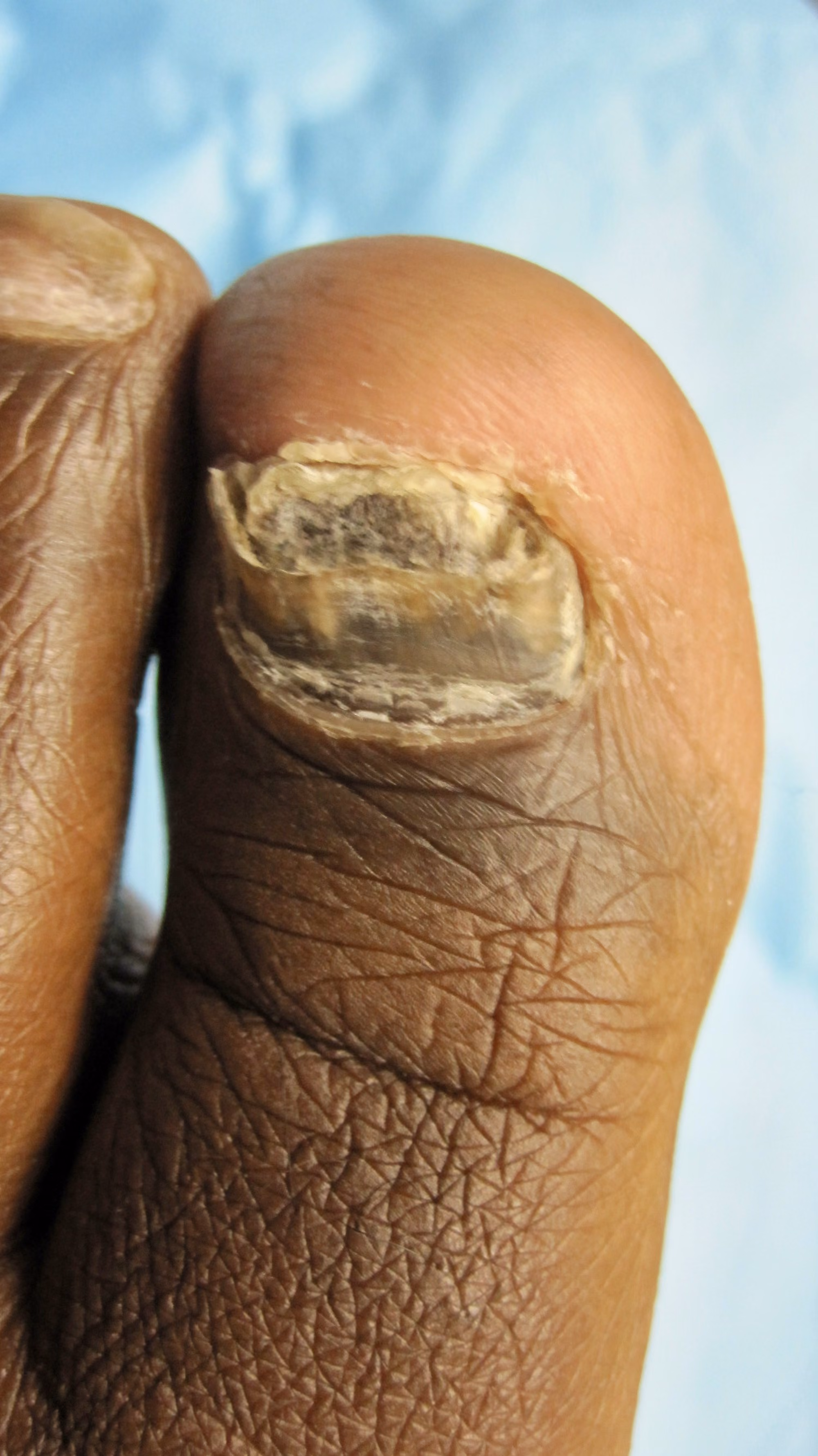 Toenail affected by fungus before laser treatment