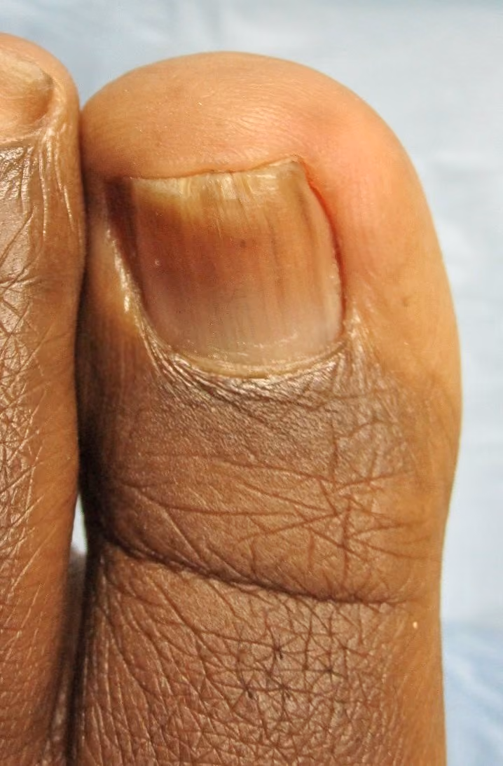 Clearer toenail after laser treatment for toenail fungus