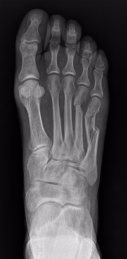 X-ray of a foot with a metatarsal fracture
